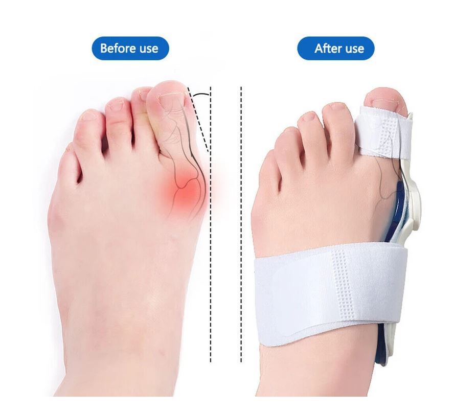 Ip Insoles Αρθρωτός νάρθηκας Βλαισού Μεγάλου Δακτύλου IP 018 αμφιδέξιος Ip Insoles Αρθρωτός νάρθηκας Βλαισού Μεγάλου Δακτύλου IP 018 αμφιδέξιος